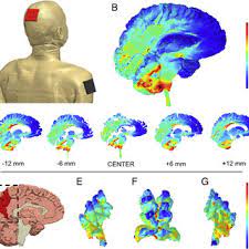 R32_ tES Estimulación Eléctrica Transcraneal
